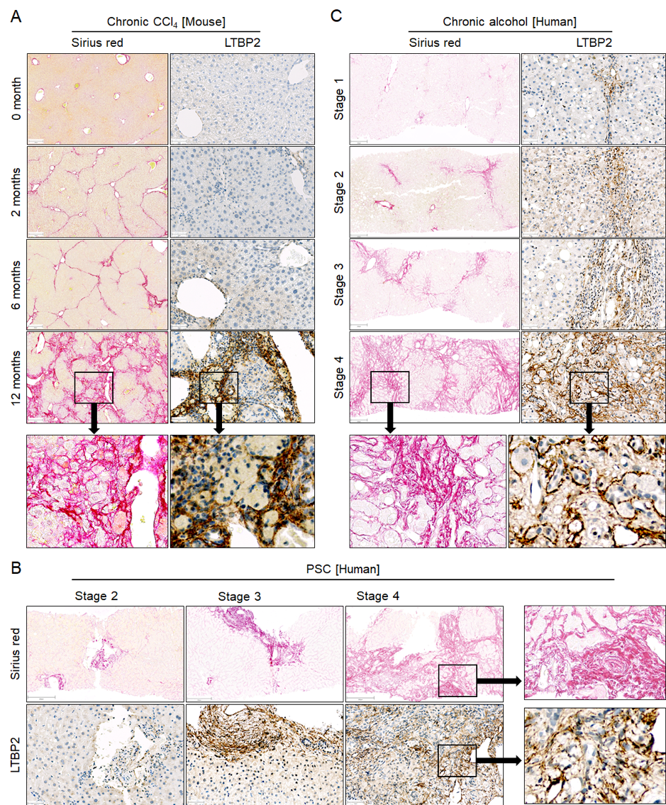 The extracellular matrix protein LTBP2 increases in CLD of mice and humans. A. Liver tissue of mice at different time periods after CCl~4~ treatment. B. Liver tissue of patients with different stages of PSC. C. Liver tissue of patients with ARLD of different stages. Stainings were performed with Sirius red (scale bars 200 µm) to visualize fibrosis and with antibodies against LTBP2 (scale bars 200 µm) in liver tissue of the same patients. The entire figure was provided by Ahmed Ghallab.