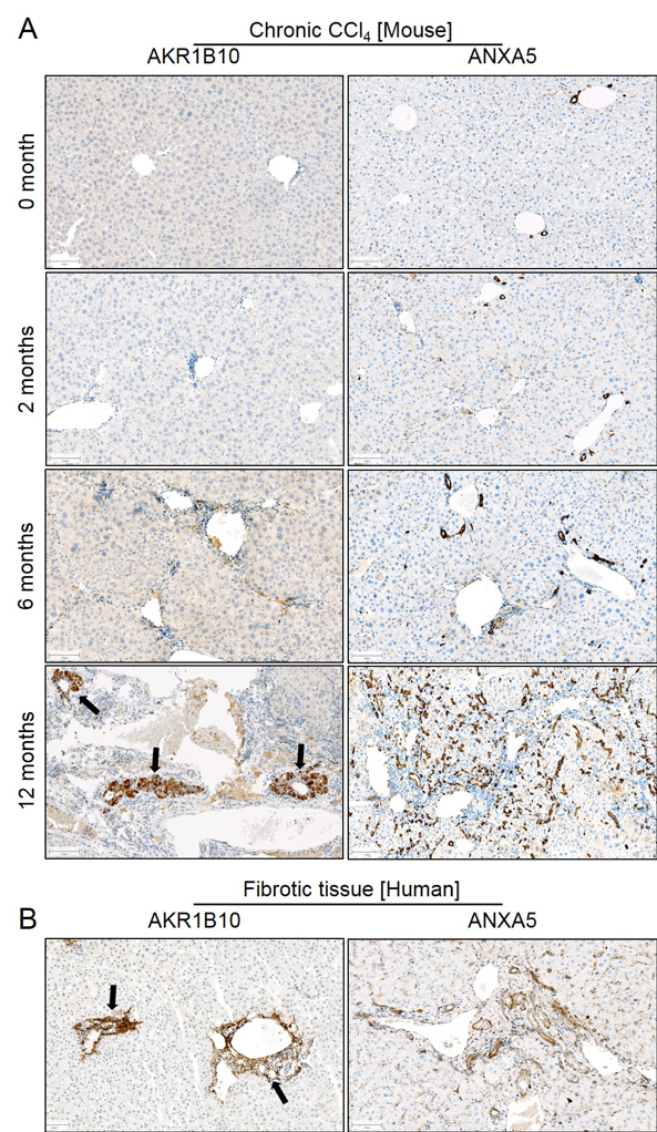 Aldo-keto reductase (AKR1B10) and annexin V (ANXA5) increase in CLD of mice and humans. A. Immunostaining of AKR1B10 and ANXA5 at different stages during CLD progression induced by chronic CCl~4~ administration in mice; AKR1B10 shows clusters of positive signals at 12 months (arrows); ANXA5 stained positive in the progressive ductular reaction. B. AKR1B10 and ANXA5 immunostaining in fibrotic tissues of human patients showing similar expression patterns as in mice. Scale bars: 100 µm. The entire figure was provided by Ahmed Ghallab.